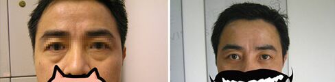 做手术去眼袋好不好