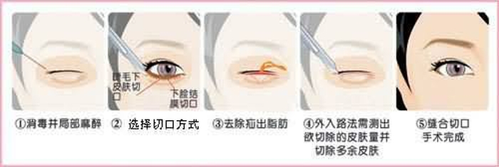 祛眼袋有几种方法
