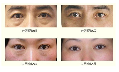 有什么办法可以消除眼袋