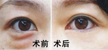 有什么办法可以消除眼袋