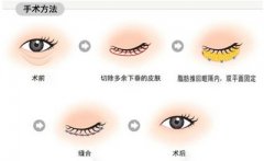 如何才能消除眼袋 如何才能消除眼袋