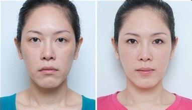 如何才能消除眼袋