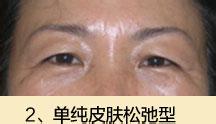 怎么样可以去除眼袋 韩式祛眼袋手术优势