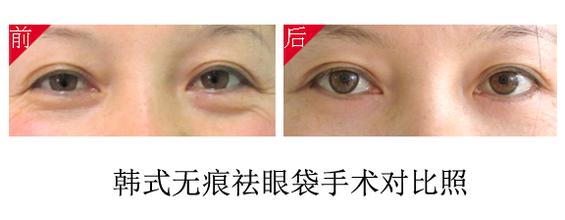 韩式微创精细去眼袋手术方法