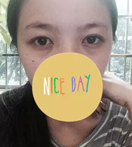 什么是微创去眼袋