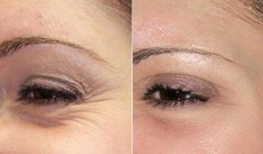 鱼尾纹可以用电波l皮去除吗