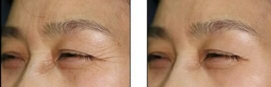 玻尿酸去鱼尾纹成好吗