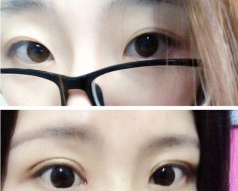 韩式开眼角手术有什么优势