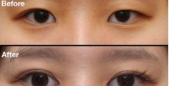 开眼角手术的果怎么样 开眼角手术的果怎么样