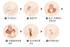 巨大乳房缩小果可以保持多久 巨大乳房缩小果可以保持多久