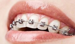什么是牙槽骨修整术 为什么要做牙槽骨修整术