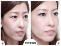 韩式热熔去眼袋果怎么样 韩式热熔去眼袋果怎么样