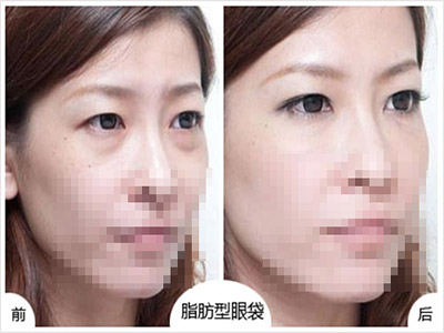 韩式热熔去眼袋果怎么样