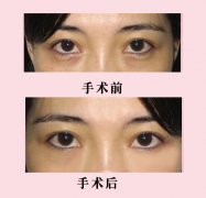 韩式泪感去眼袋果怎么样 韩式泪感去眼袋果怎么样