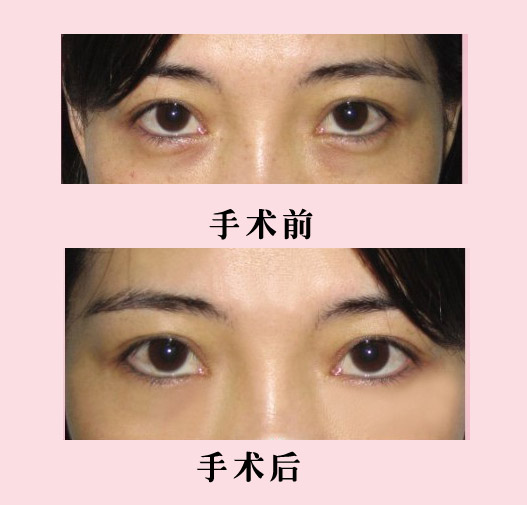 韩式泪感去眼袋果怎么样