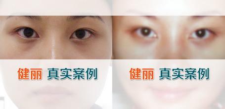 吸脂祛眼袋手术果怎么样