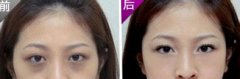 形成眼袋和眼圈的原因 形成眼袋和眼圈的原因