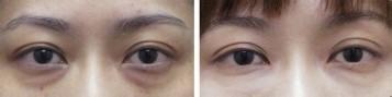 激光去黑眼圈的缓解果好不好