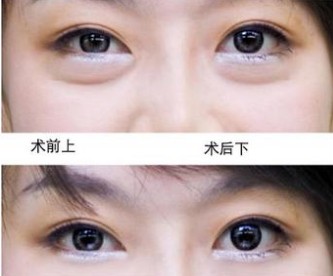 各类祛眼袋的手术方法