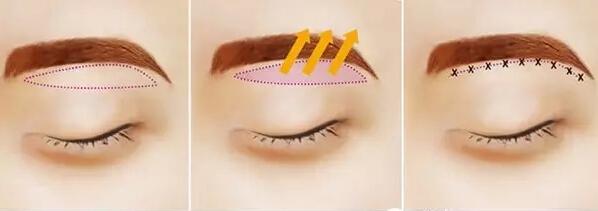 切眉手术前后对比照片