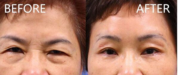 提眉手术功有哪些