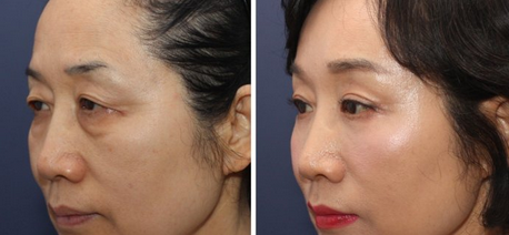 提眉手术功有哪些