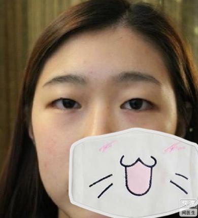 有了眼袋该怎么办