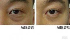 激光去眼袋和黑眼圈注意事项 激光去眼袋和黑眼圈注意事项