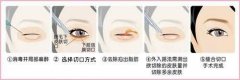 眼袋外切和内切的区别 眼袋外切和内切的区别