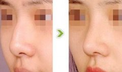 驼峰鼻可以矫正吗