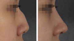 驼峰鼻矫正要多少钱