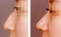 驼峰鼻矫正注意事项有哪些