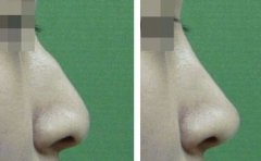 做驼峰鼻矫正的成好吗