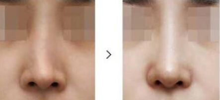 隆鼻失败修复术需要多少钱