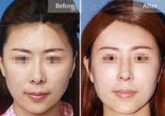 假体隆鼻失败容易取出吗