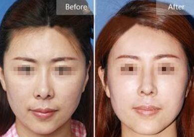 假体隆鼻失败容易取出吗