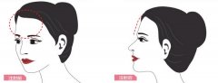 玻尿酸丰额头有哪些优点