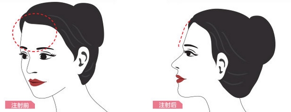 玻尿酸丰额头,有哪些优点