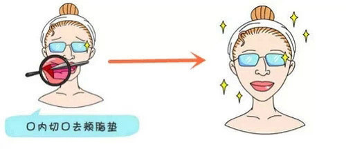 去颊脂垫手术,让脸凹陷