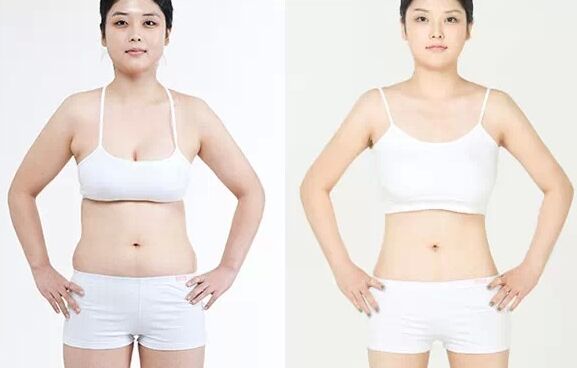 吸脂减肥对身体有什么危害吗