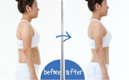 全身吸脂减肥费用多少