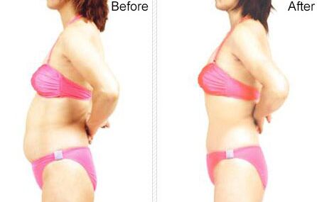 做全身吸脂减肥要注意些什么