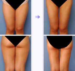 哪些人不适合做大腿吸脂