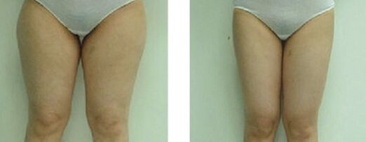 大腿吸脂有哪些副作用