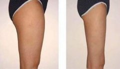 大腿吸脂术后可以维持多久