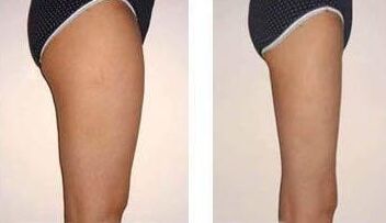 大腿吸脂术后可以维持多久