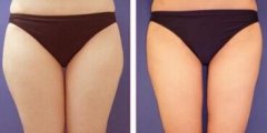 大腿吸脂多久见果