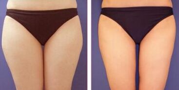 大腿吸脂多久见果