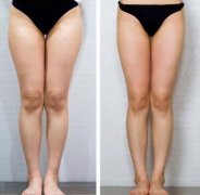 大腿吸脂的好处是什么