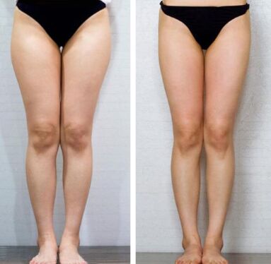 大腿吸脂的好处是什么